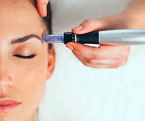 Microneedling